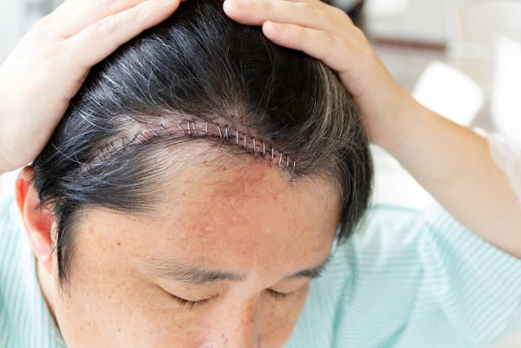 Close up of a person's hairline with stables in their head after suffering a traumatic brain injury